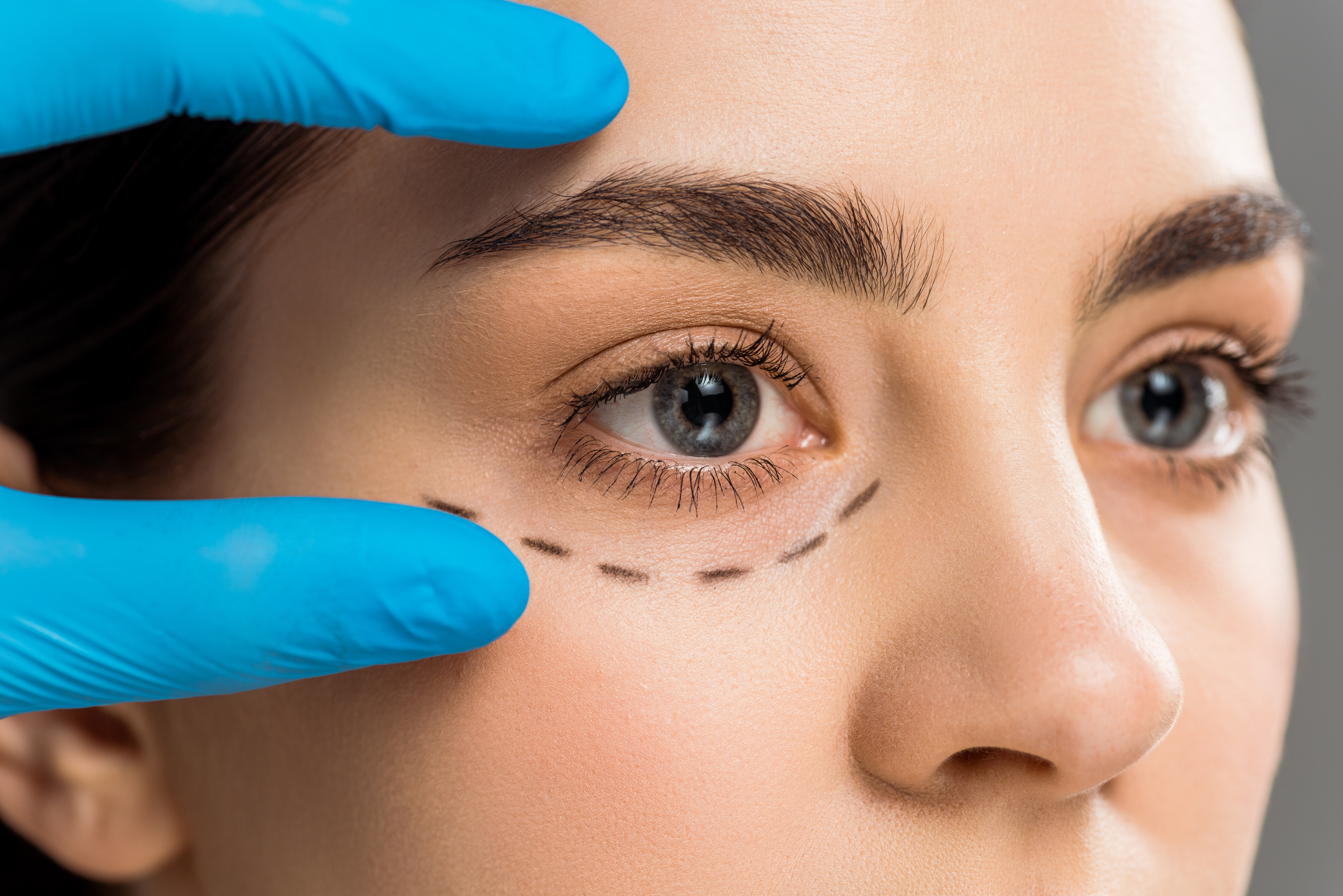 Oculoplasty treatment